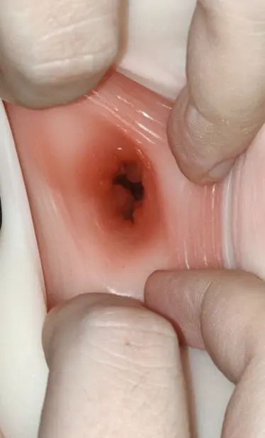 Anal opening close-up